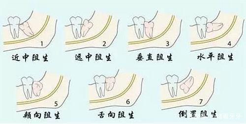 發(fā)炎的智齒什么時(shí)候拔才好？有些情況不能拔