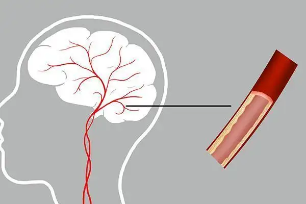 提醒中老年人：腦供血不足時(shí)，身體會(huì)發(fā)出4個(gè)信號(hào)！該如何治療？