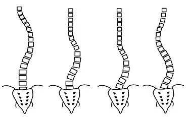 脊柱側(cè)彎如何康復(fù)？河南省中醫(yī)院西區(qū)醫(yī)院專家這樣說