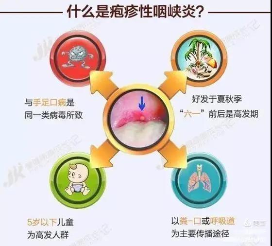 皰疹性咽峽炎及手足口病不用慌，紫外線燈來幫忙