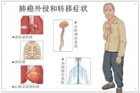 腿疼被診斷為肺癌晚期？腿上出現(xiàn)這4種現(xiàn)象，千萬(wàn)要注意！